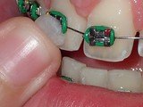 Cire orthodontique de confort